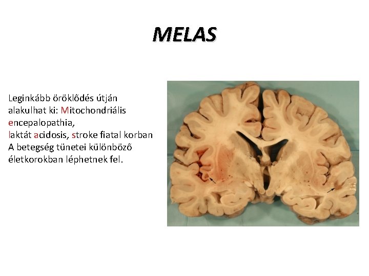 MELAS Leginkább öröklődés útján alakulhat ki: Mitochondriális encepalopathia, laktát acidosis, stroke fiatal korban A