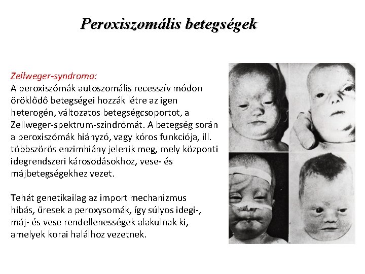 Peroxiszomális betegségek Zellweger-syndroma: A peroxiszómák autoszomális recesszív módon öröklődő betegségei hozzák létre az igen