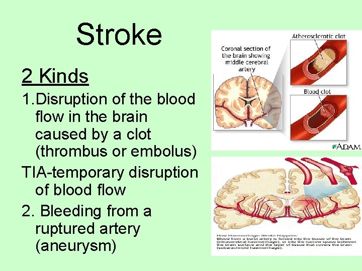 Stroke 2 Kinds 1. Disruption of the blood flow in the brain caused by