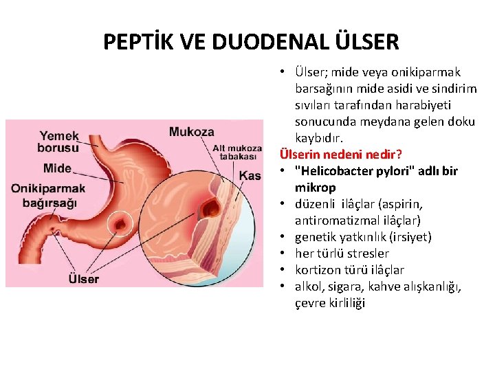 PEPTİK VE DUODENAL ÜLSER • Ülser; mide veya onikiparmak barsağının mide asidi ve sindirim