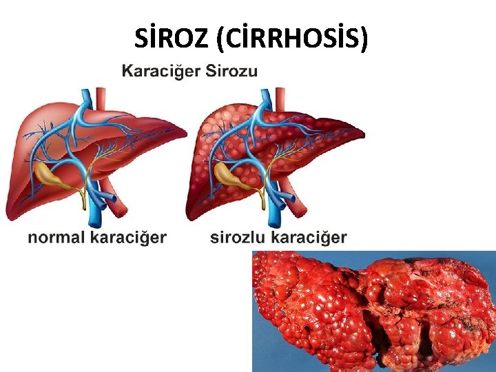 SİROZ (CİRRHOSİS) 