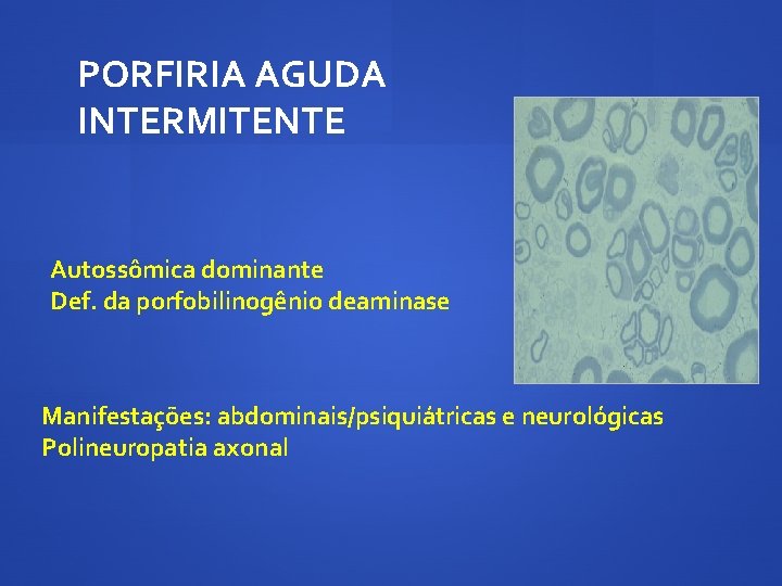 PORFIRIA AGUDA INTERMITENTE Autossômica dominante Def. da porfobilinogênio deaminase Manifestações: abdominais/psiquiátricas e neurológicas Polineuropatia