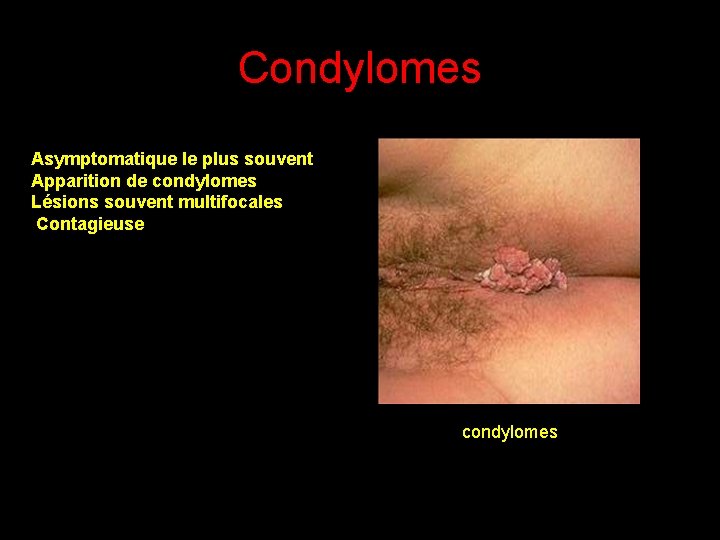 Condylomes Asymptomatique le plus souvent Apparition de condylomes Lésions souvent multifocales Contagieuse condylomes 