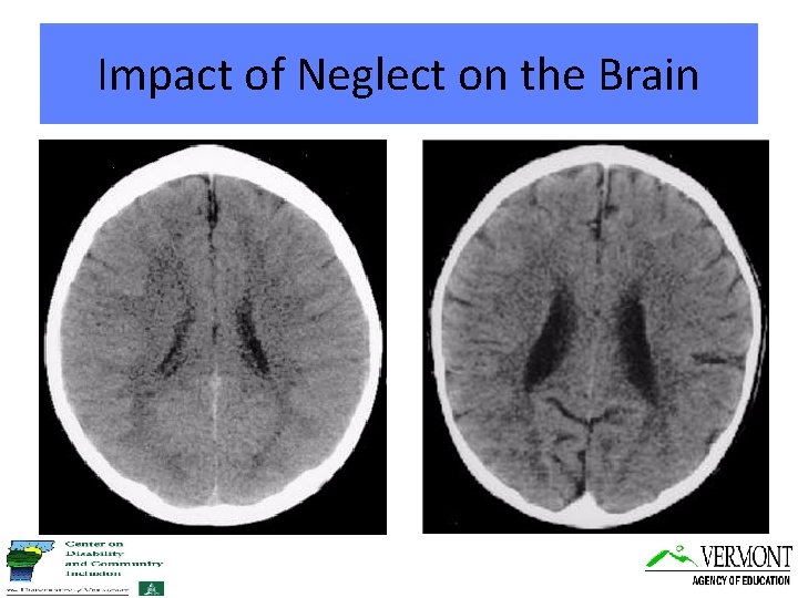 Impact of Neglect on the Brain 