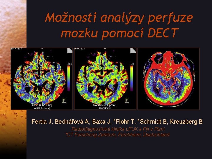 Možnosti analýzy perfuze mozku pomocí DECT Ferda J, Bednářová A, Baxa J, *Flohr T,
