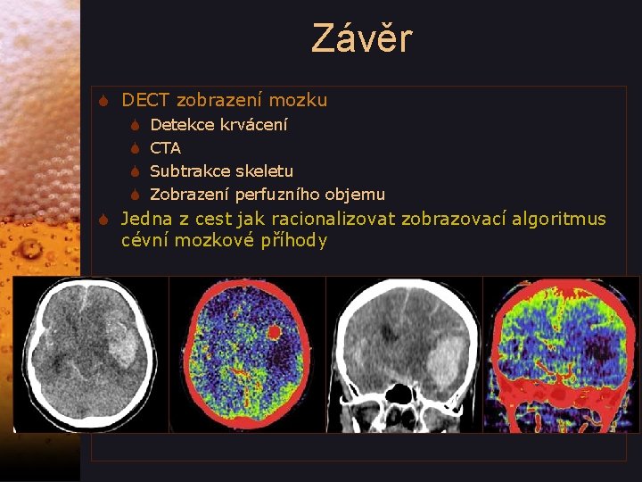 Závěr S DECT zobrazení mozku S S Detekce krvácení CTA Subtrakce skeletu Zobrazení perfuzního