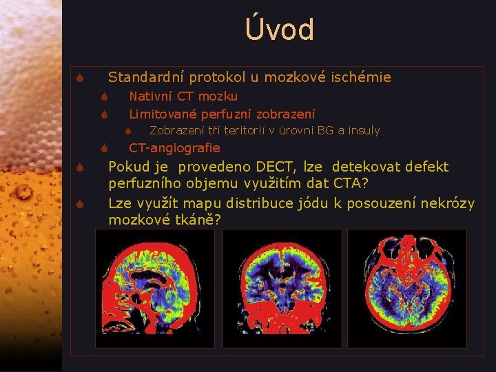 Úvod S Standardní protokol u mozkové ischémie S S Nativní CT mozku Limitované perfuzní