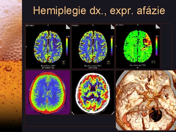 Hemiplegie dx. , expr. afázie 