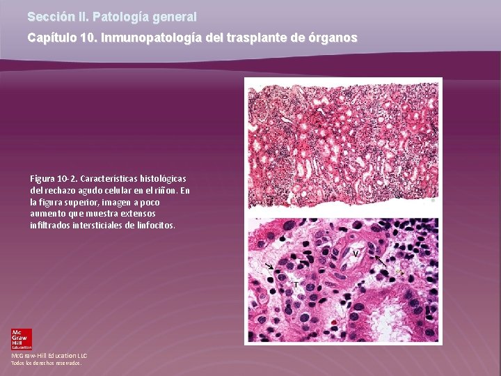 Sección II. Patología general Capítulo 10. Inmunopatología del trasplante de órganos Figura 10 -2.
