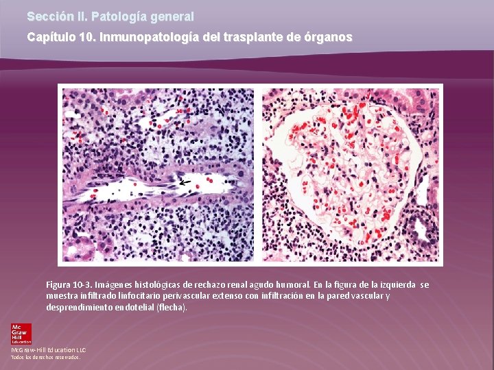Sección II. Patología general Capítulo 10. Inmunopatología del trasplante de órganos Figura 10 -3.