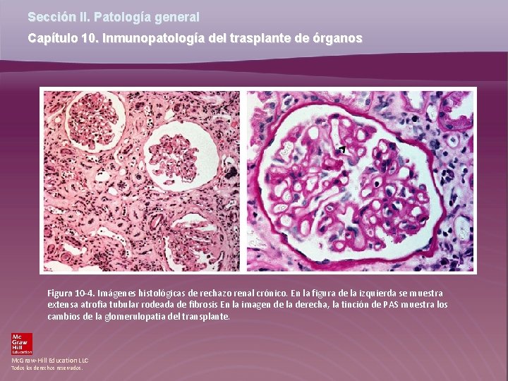 Sección II. Patología general Capítulo 10. Inmunopatología del trasplante de órganos Figura 10 -4.