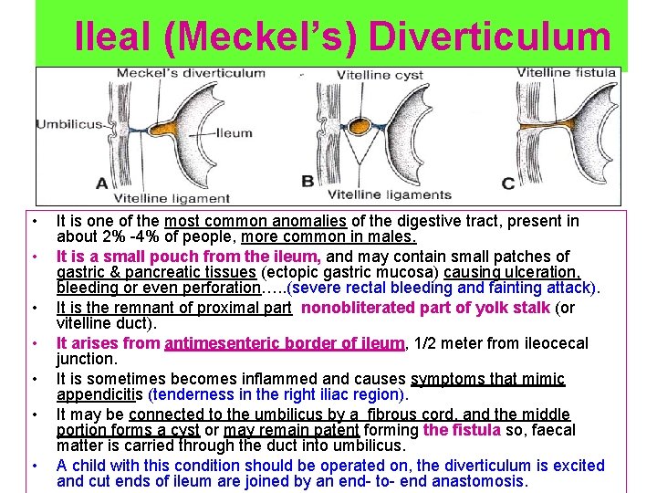 Ileal (Meckel’s) Diverticulum • • It is one of the most common anomalies of