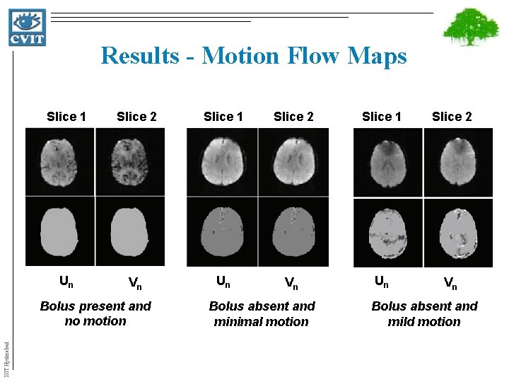 Results - Motion Flow Maps Slice 1 Slice 2 Un Vn IIIT Hyderabad Bolus