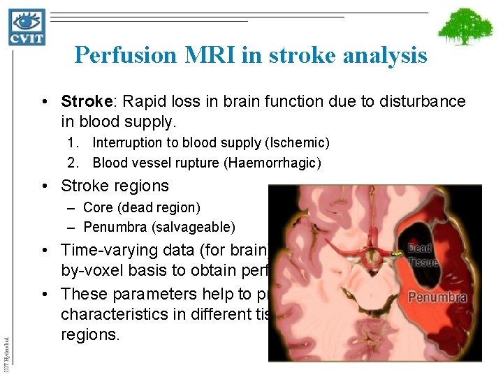 Perfusion MRI in stroke analysis • Stroke: Rapid loss in brain function due to