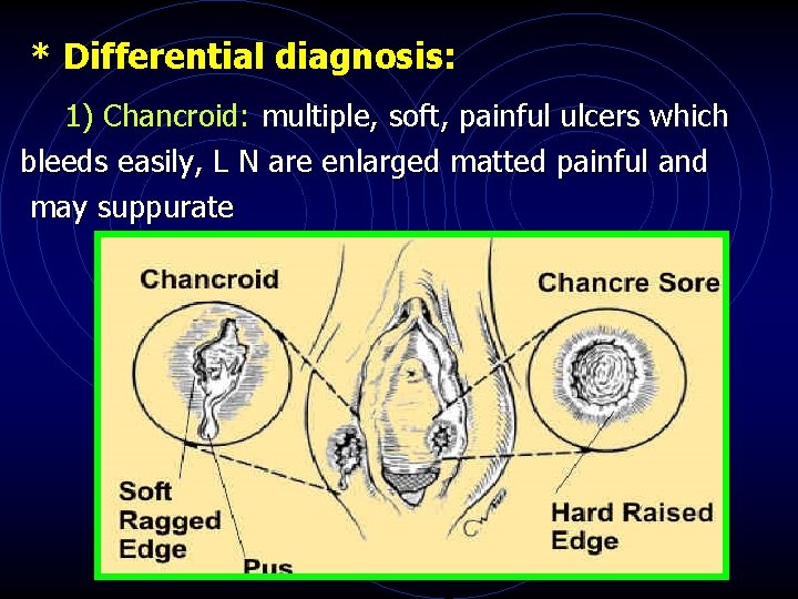 * Differential diagnosis: 1) Chancroid: multiple, soft, painful ulcers which bleeds easily, L N