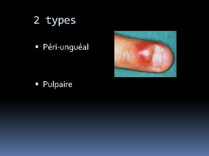 2 types Péri-unguéal Pulpaire 