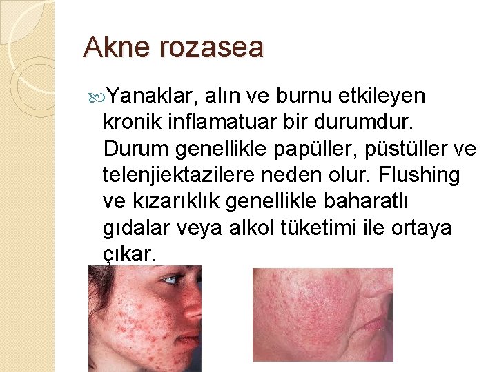 Akne rozasea Yanaklar, alın ve burnu etkileyen kronik inflamatuar bir durumdur. Durum genellikle papüller,