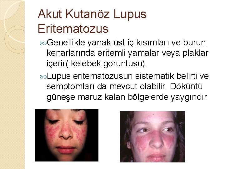 Akut Kutanöz Lupus Eritematozus Genellikle yanak üst iç kısımları ve burun kenarlarında eritemli yamalar