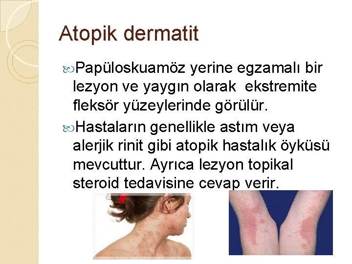 Atopik dermatit Papüloskuamöz yerine egzamalı bir lezyon ve yaygın olarak ekstremite fleksör yüzeylerinde görülür.