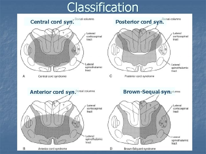 Classification Central cord syn. Anterior cord syn. Posterior cord syn. Brown-Sequal syn. 
