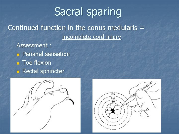 Sacral sparing Continued function in the conus medularis = incomplete cord injury Assessment :