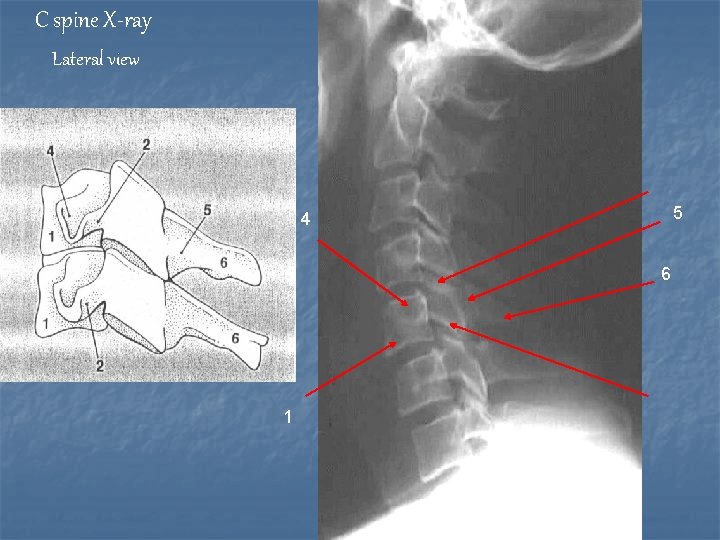 C spine X-ray Lateral view 5 4 6 1 