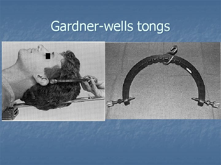 Gardner-wells tongs 