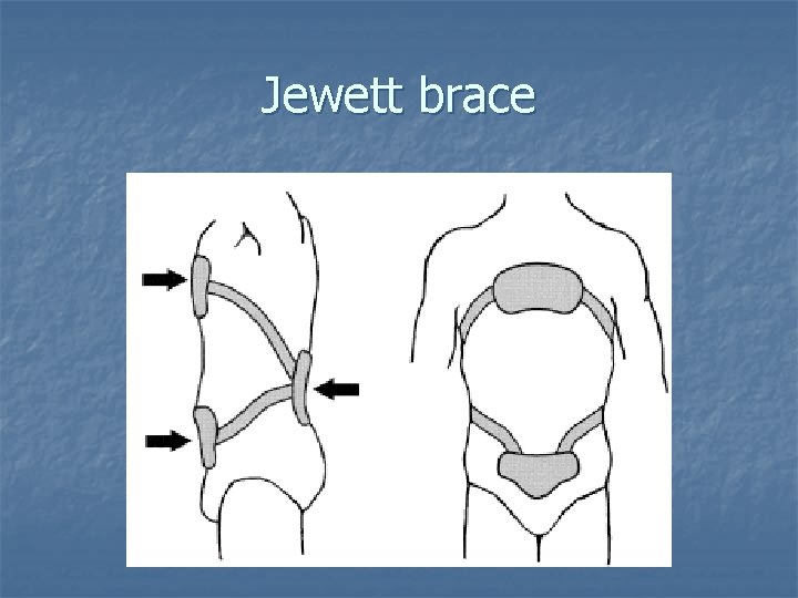 Jewett brace 