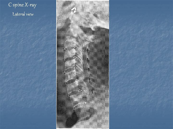 C spine X-ray Lateral view 