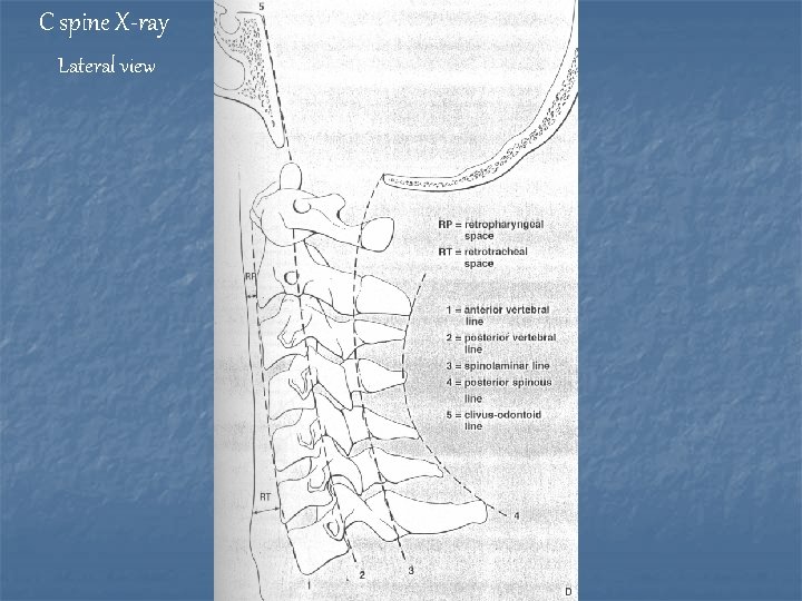 C spine X-ray Lateral view 