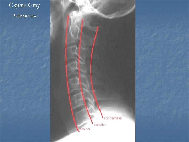 C spine X-ray Lateral view 