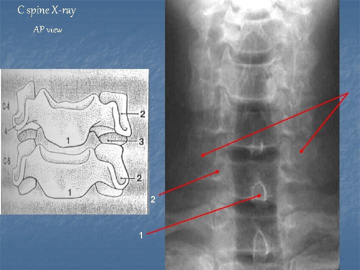 C spine X-ray AP view 2 1 
