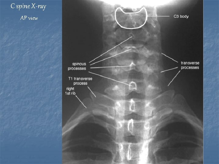 C spine X-ray AP view 