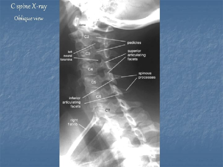 C spine X-ray Oblique view 