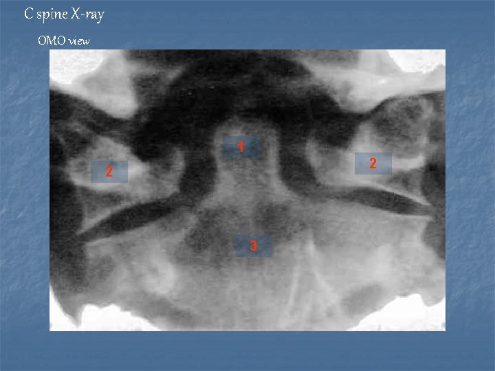 C spine X-ray OMO view 1 2 2 3 