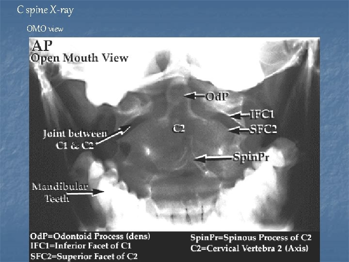 C spine X-ray OMO view 