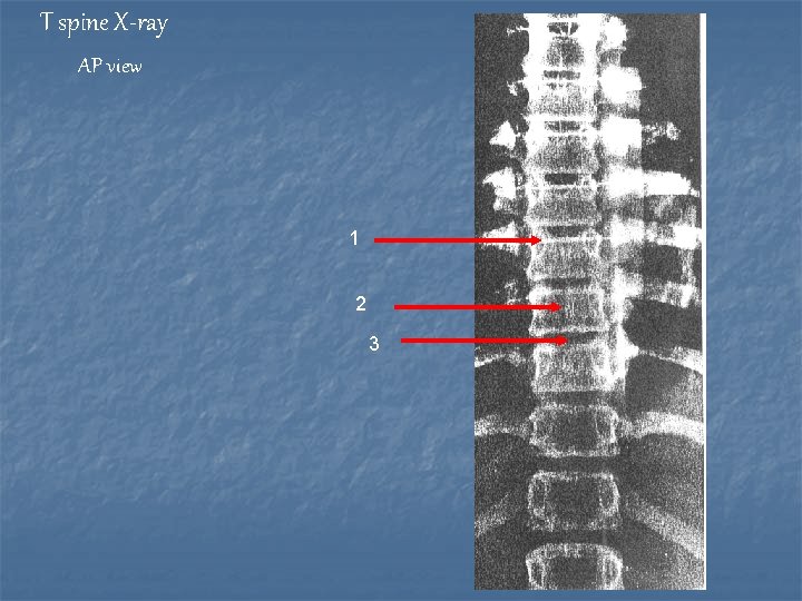T spine X-ray AP view 1 2 3 