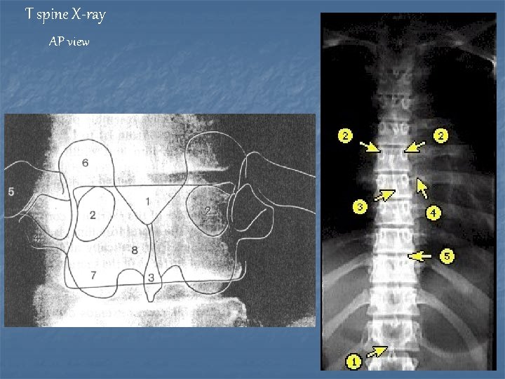 T spine X-ray AP view 
