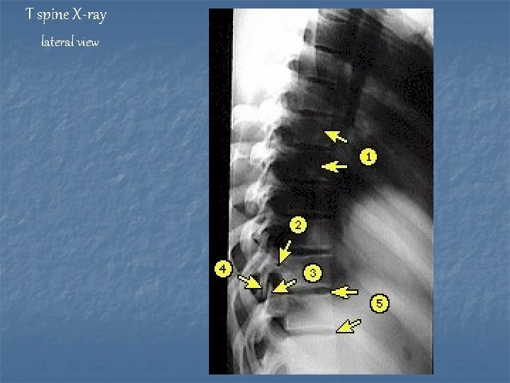 T spine X-ray lateral view 