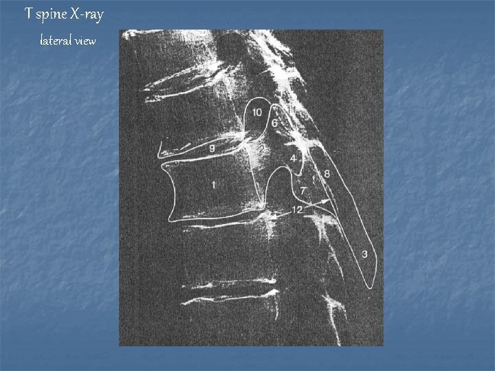 T spine X-ray lateral view 