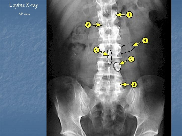 L spine X-ray AP view 
