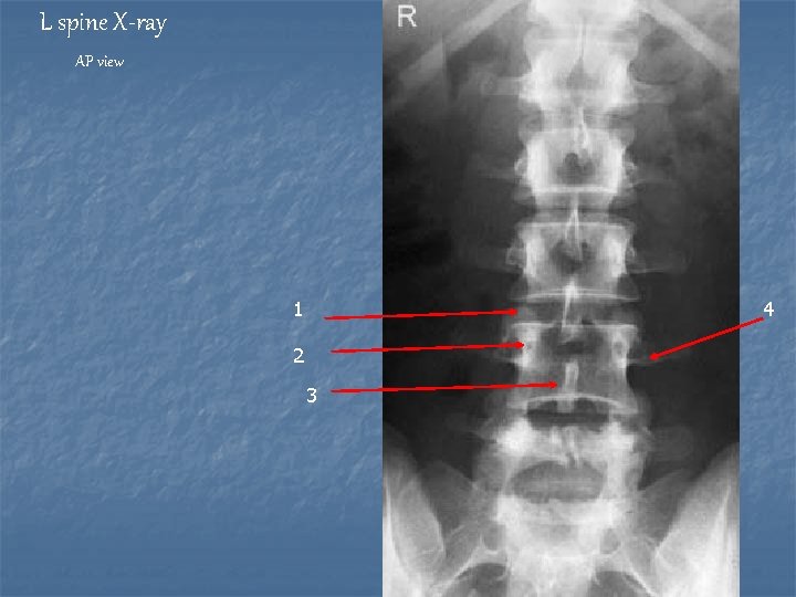 L spine X-ray AP view 1 4 2 3 