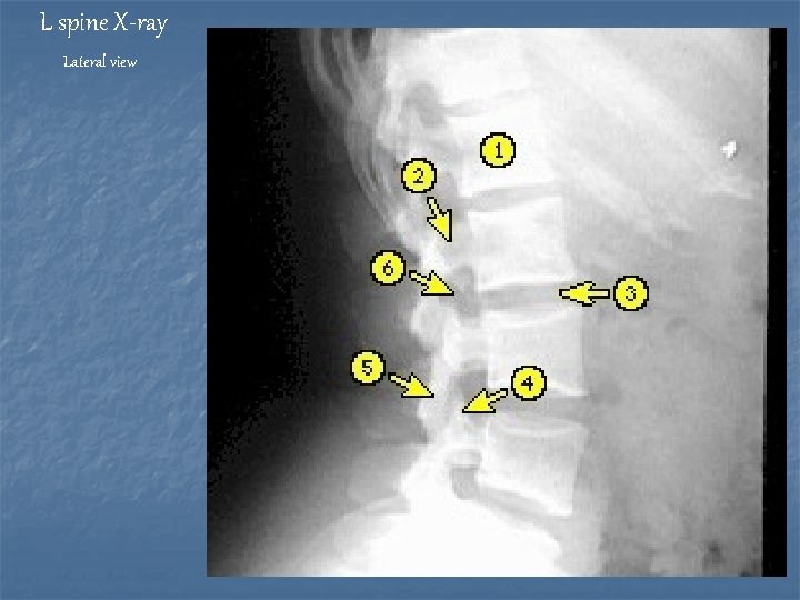 L spine X-ray Lateral view 