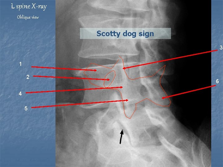 L spine X-ray Oblique view Scotty dog sign 3 1 2 4 5 6