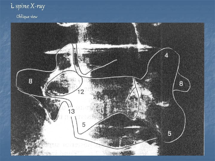 L spine X-ray Oblique view Scotty dog 