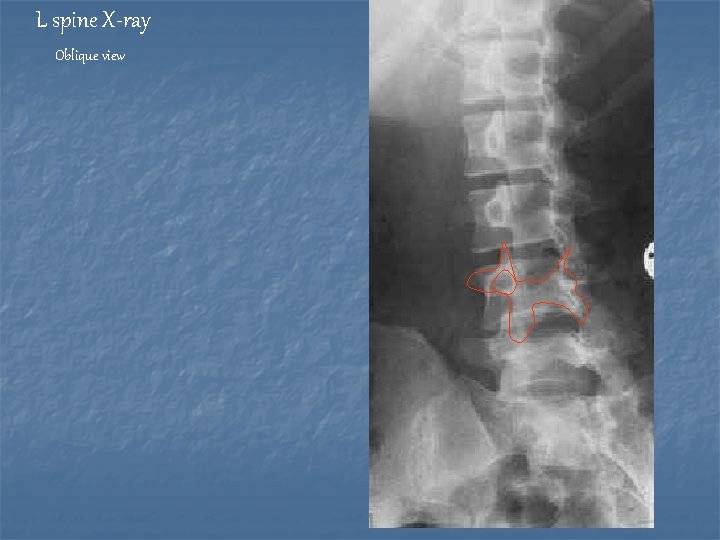 L spine X-ray Oblique view 