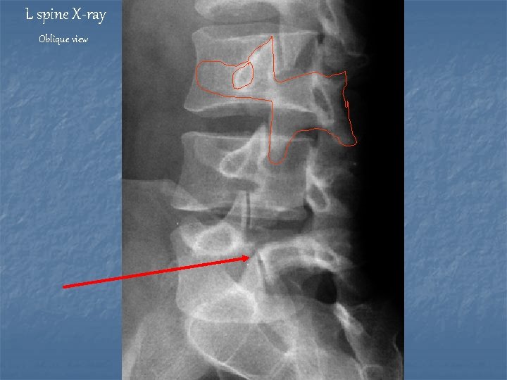 L spine X-ray Oblique view 
