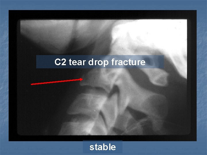 C 2 tear drop fracture stable 