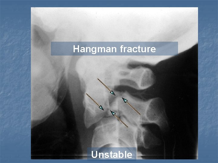 Hangman fracture Unstable 