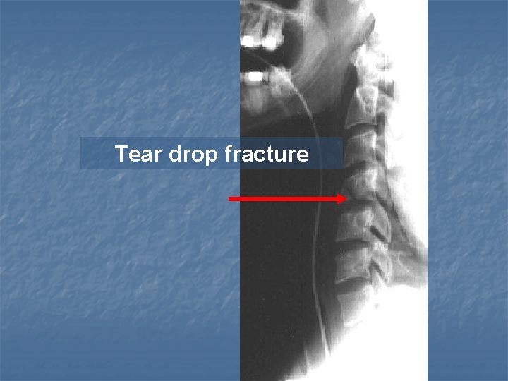 Tear drop fracture 